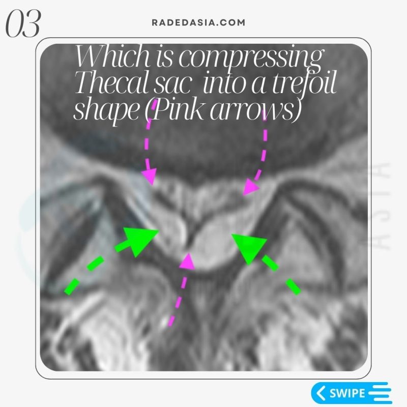 spine-epidural-lipomatosis-lumbar-mri-radiology-sac-thecal-radedasia.jpg