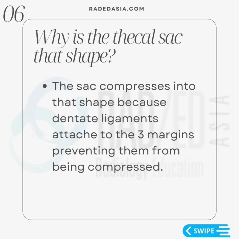 spine-epidural-lipomatosis-lumbar-mri-radiology-thecal-sac.jpg