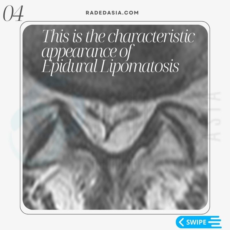 spine-epidural-lipomatosis-lumbar-mri-radiology-thecal-sac-radedasia.jpg