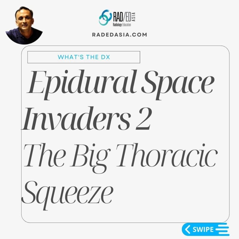 thoracic-epidural-lipomatosis-spinal-spine-radiology-mri-radedasia.jpg